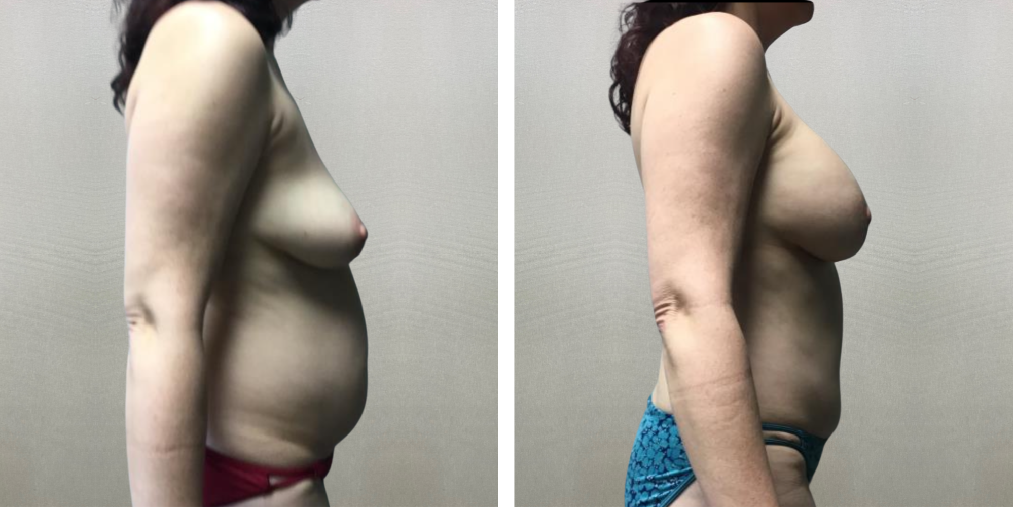 Mommy Makeover in Detroit Michigan ()