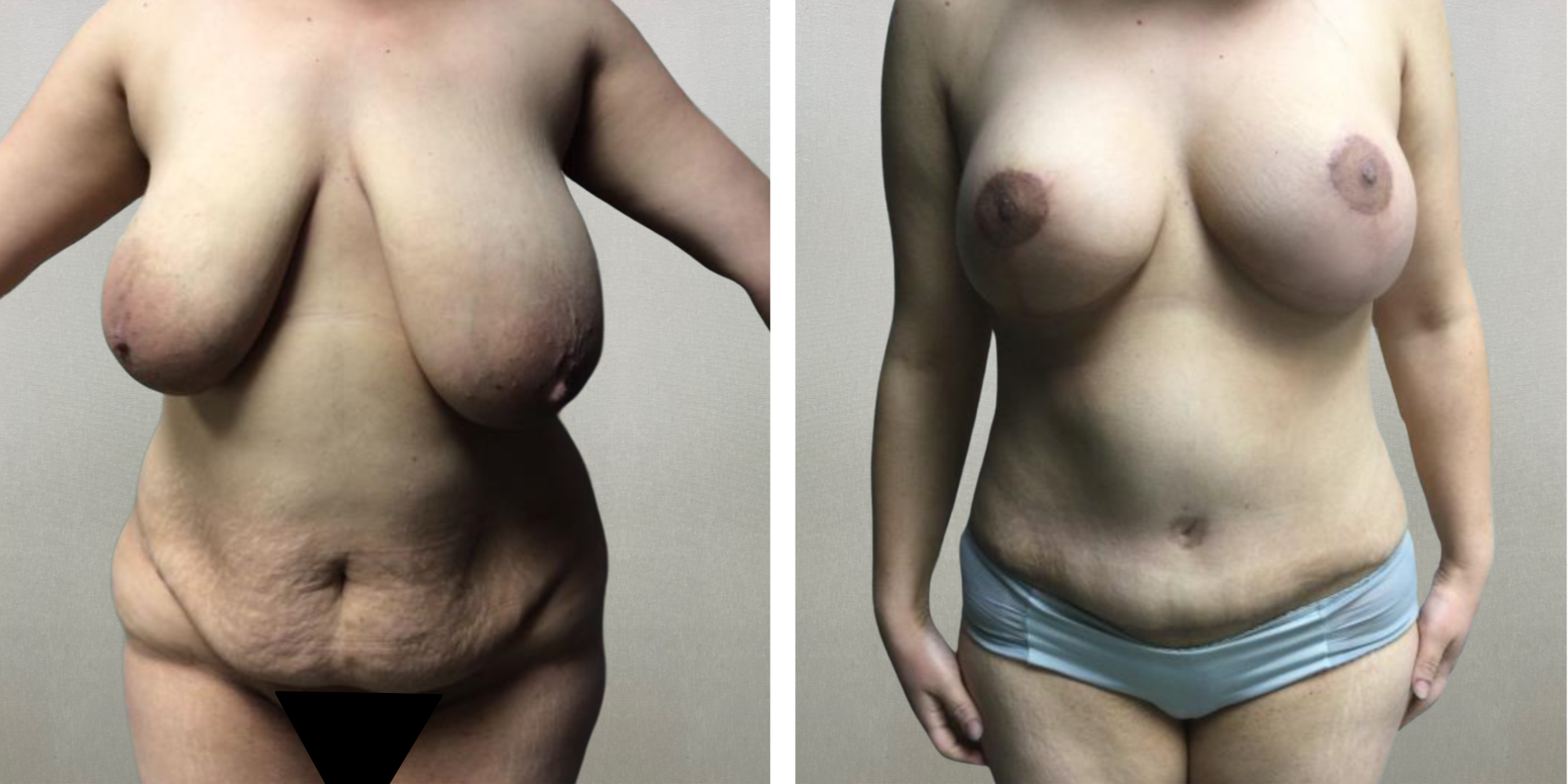 Mommy Makeover in Detroit Michigan