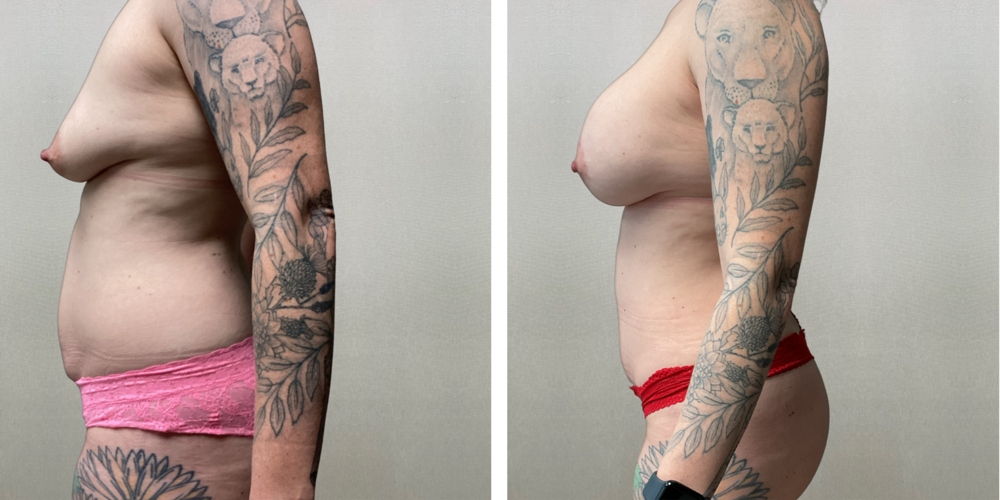 Mommy Makeover in Detroit metro ()