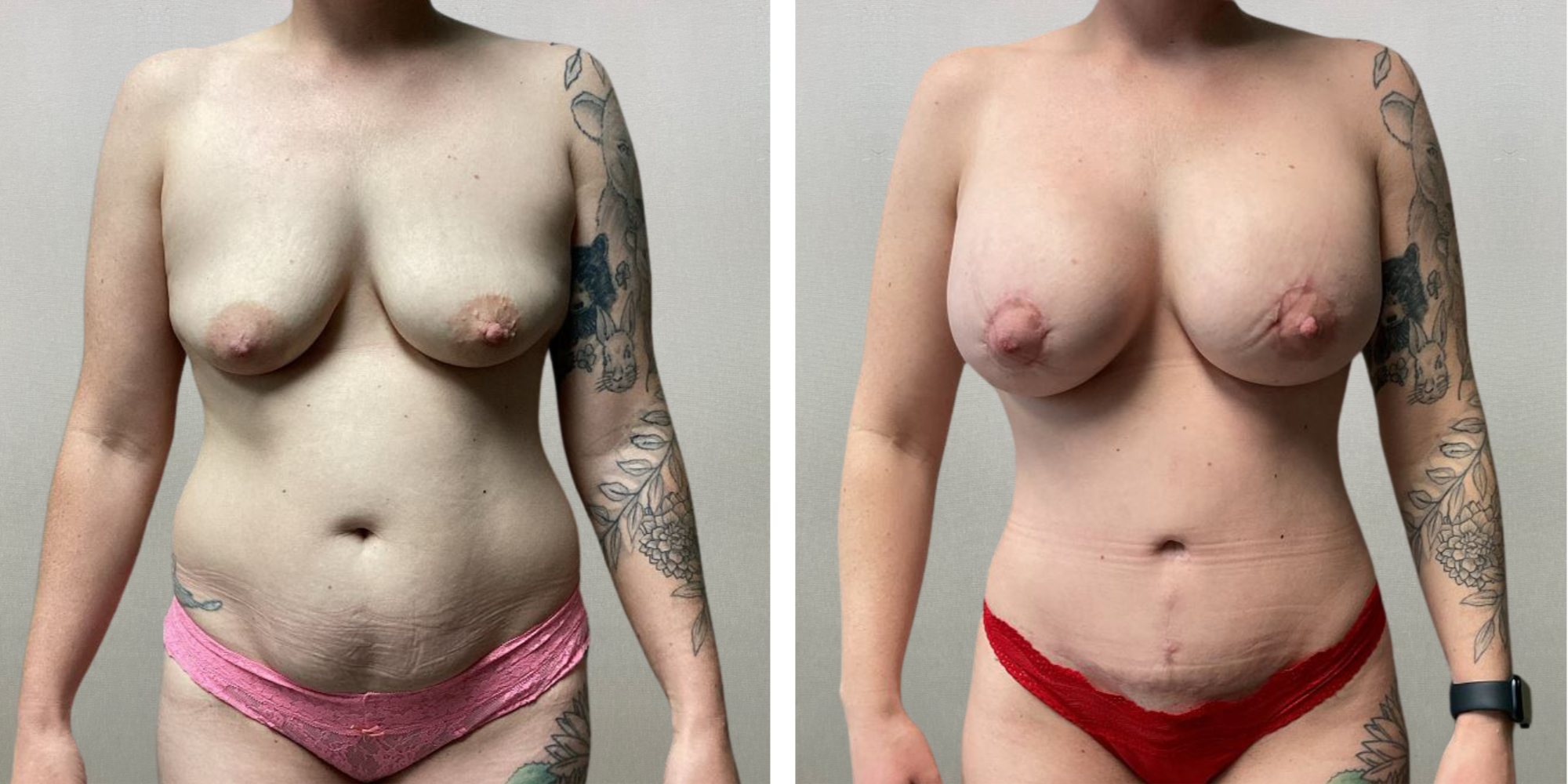 Mommy Makeover in Detroit metro