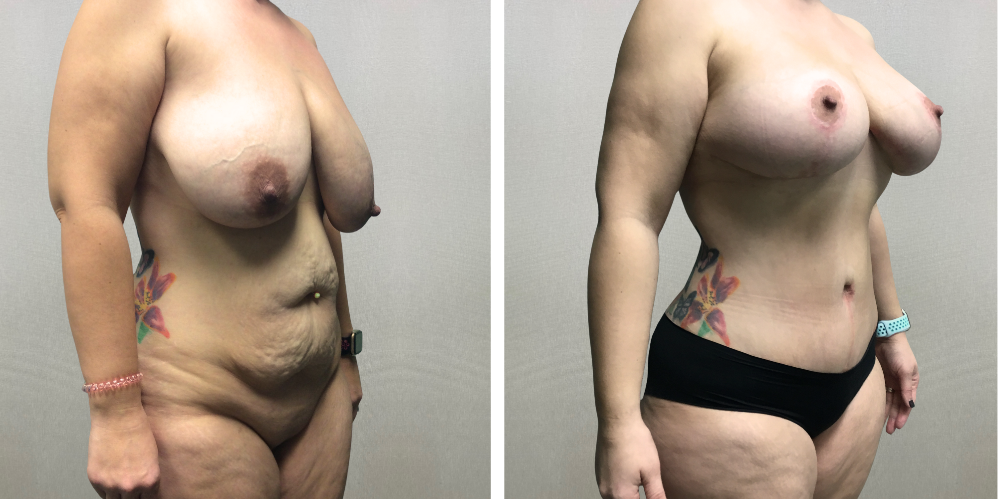 Mommy Makeover with Tummy Tuck and breast reduction