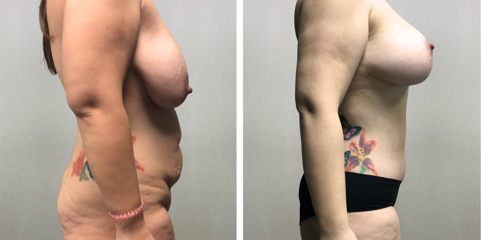 Mommy Makeover with Tummy Tuck and breast reduction