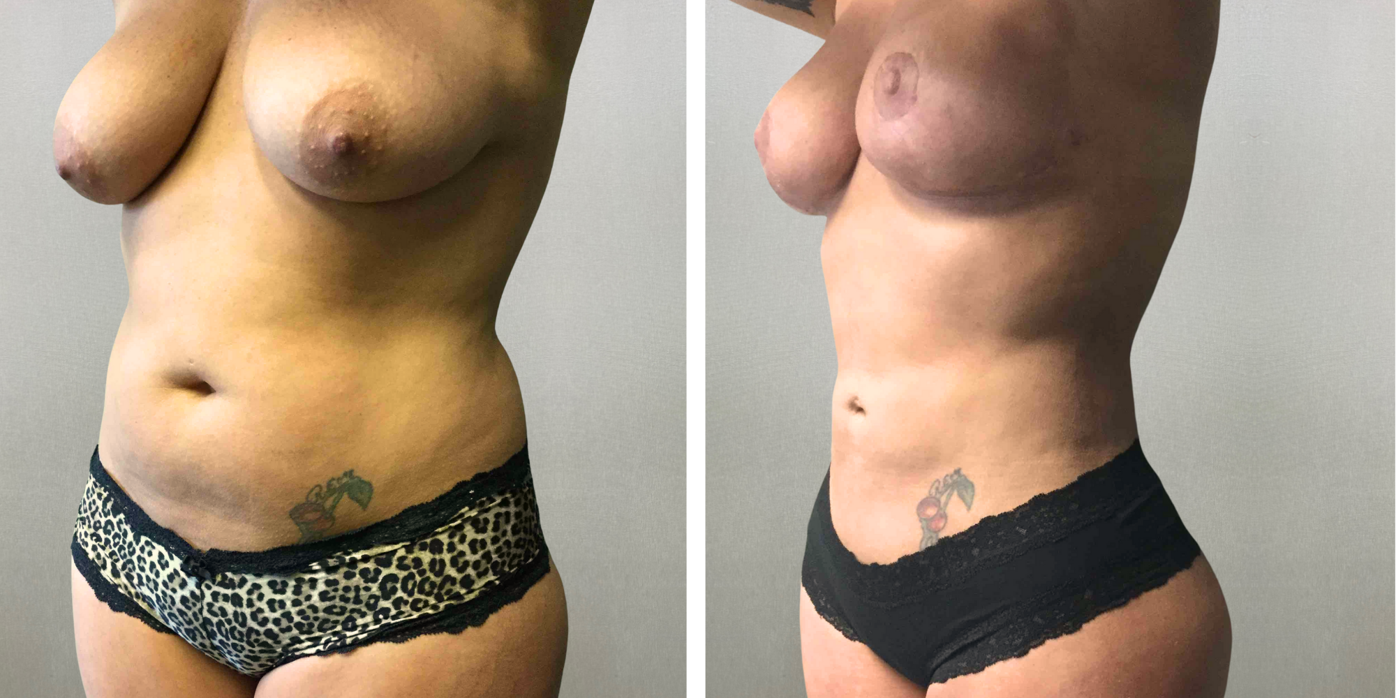 Mommy Makeover with Tummy Tuck and breast reduction in michigan ()
