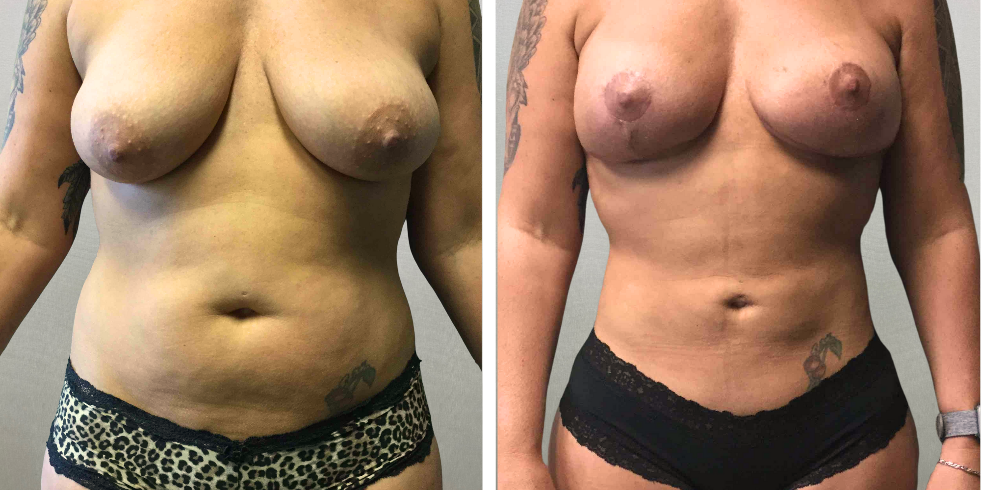 Mommy Makeover with Tummy Tuck and breast Lift in michigan
