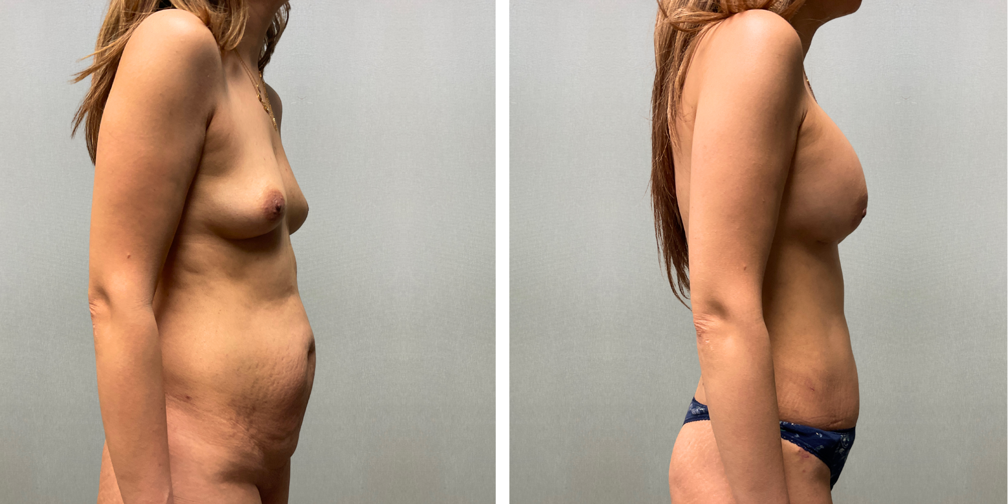Mommy Makeover with Tummy Tuck and silicone breast augmentation in Detroirt ()