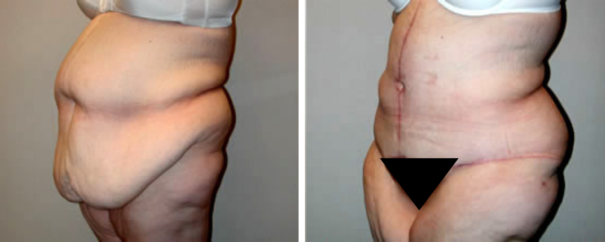 Weight Loss Makeover Body Lift in Michigan ()