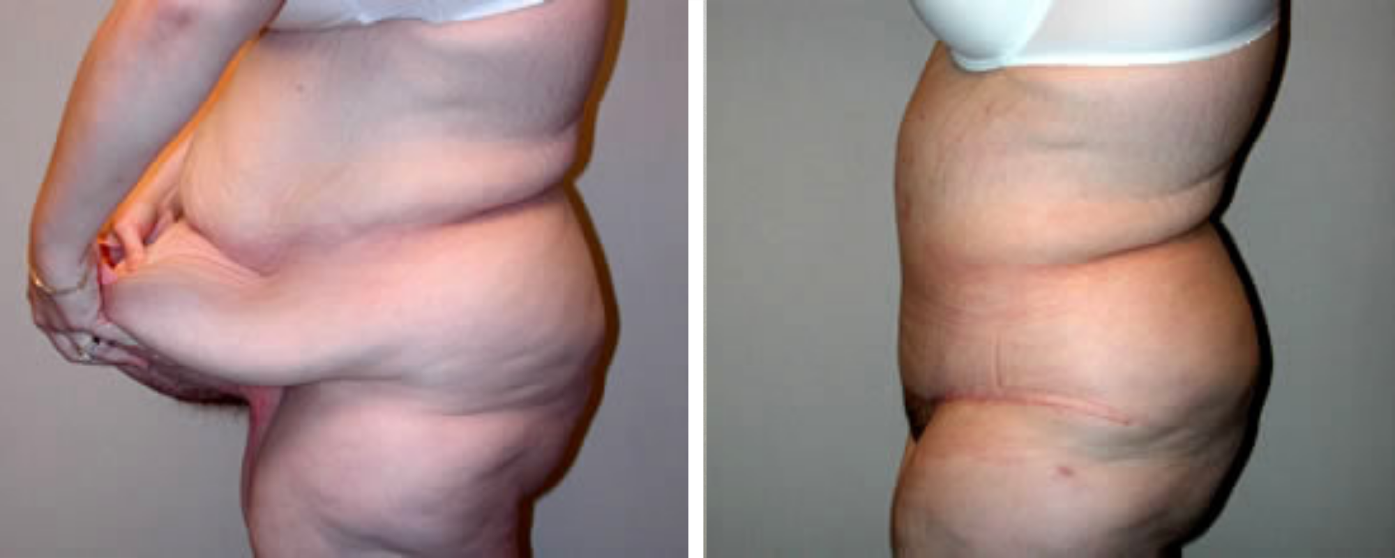 Weight Loss Makeover Body Lift in Michigan ()
