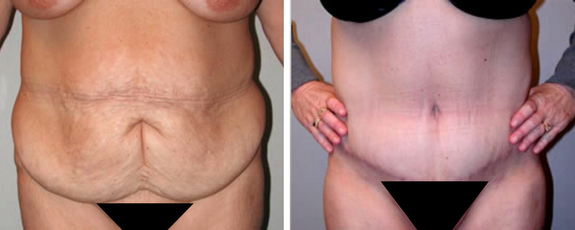 Weight Loss Makeover Body Lift in Michigan ()
