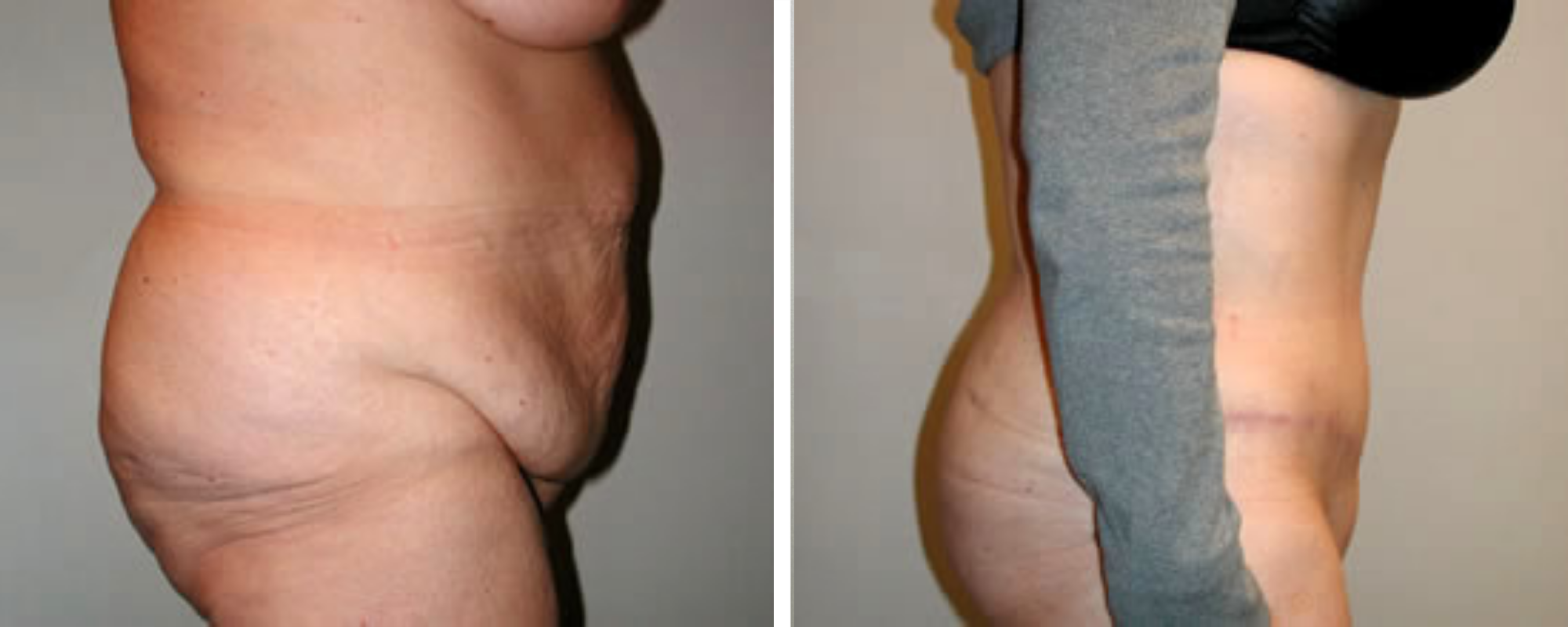 Weight Loss Makeover Body Lift in Michigan ()